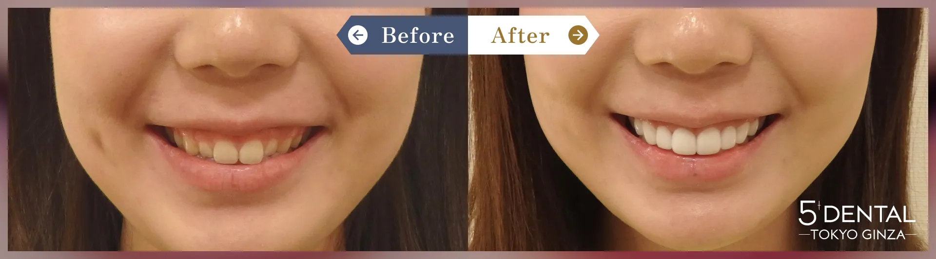 ガミースマイル治療 Before/After症例6