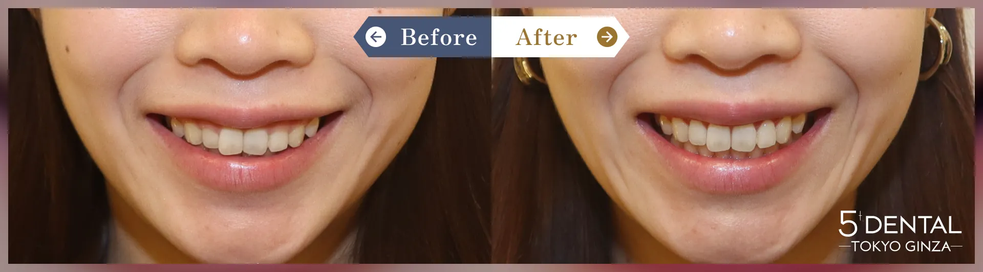 ガミースマイル治療 Before/After症例9