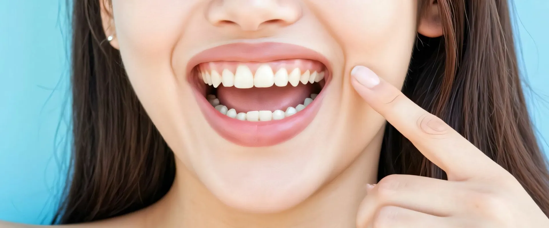 【症例集】削らないラミネートベニア