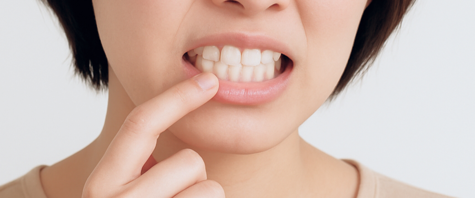 インビザラインGOに適しているケース