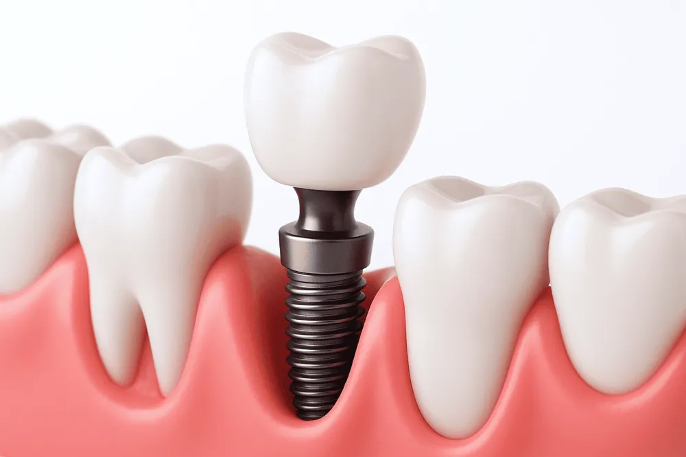 インビザラインGOマウスピース