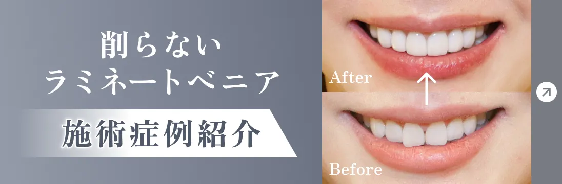 【施術症例紹介】削らないラミネートべニア