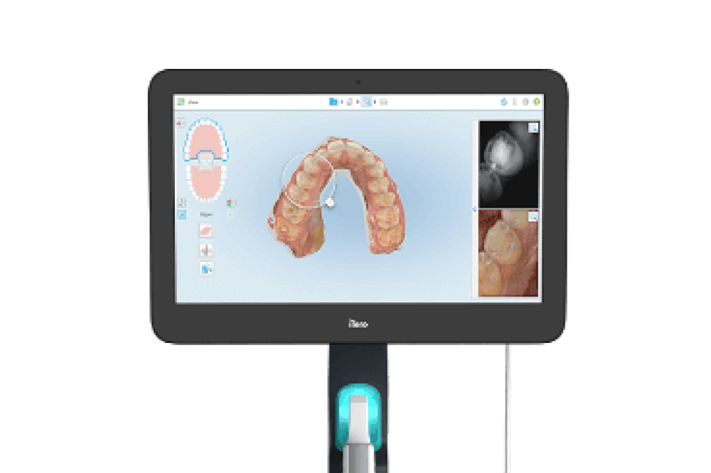 iTeroスキャナー