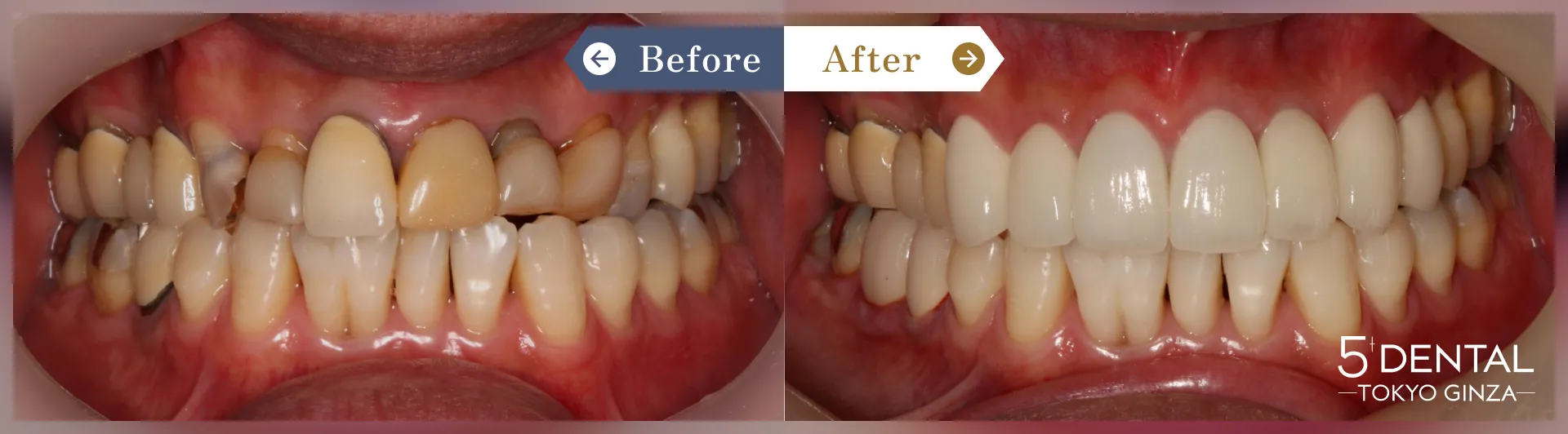 差し歯の色 Before/After症例1
