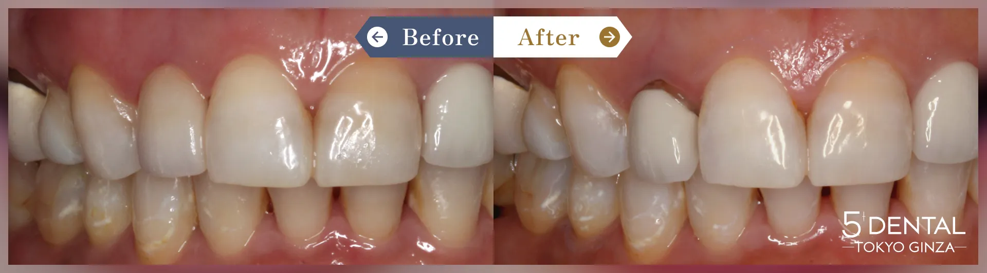 差し歯の色 Before/After症例3