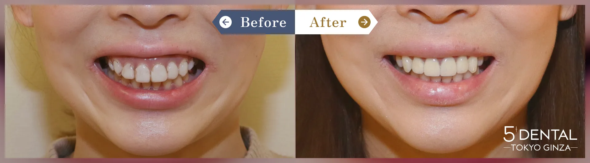Case1 上前歯4本 セラミッククラウン + 歯肉整形