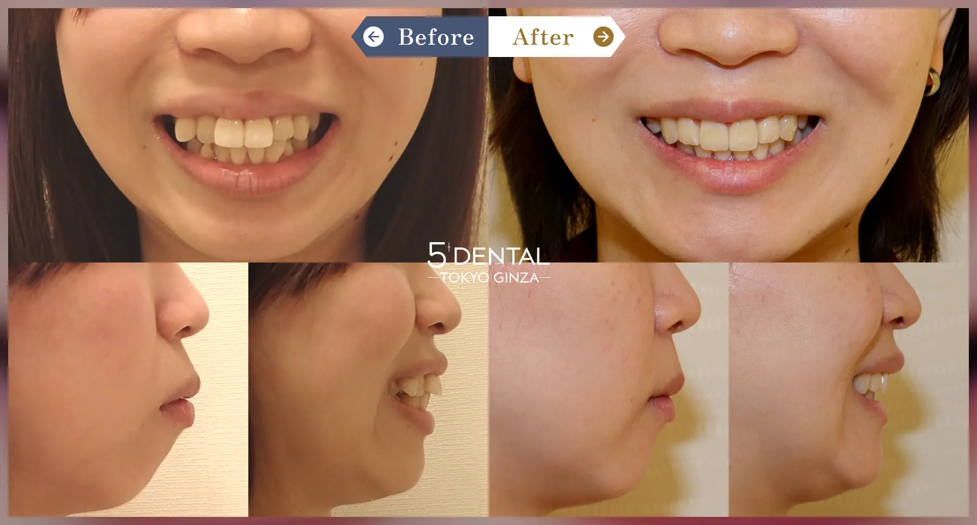 Case3 ワイヤー矯正＋マウスピース矯正