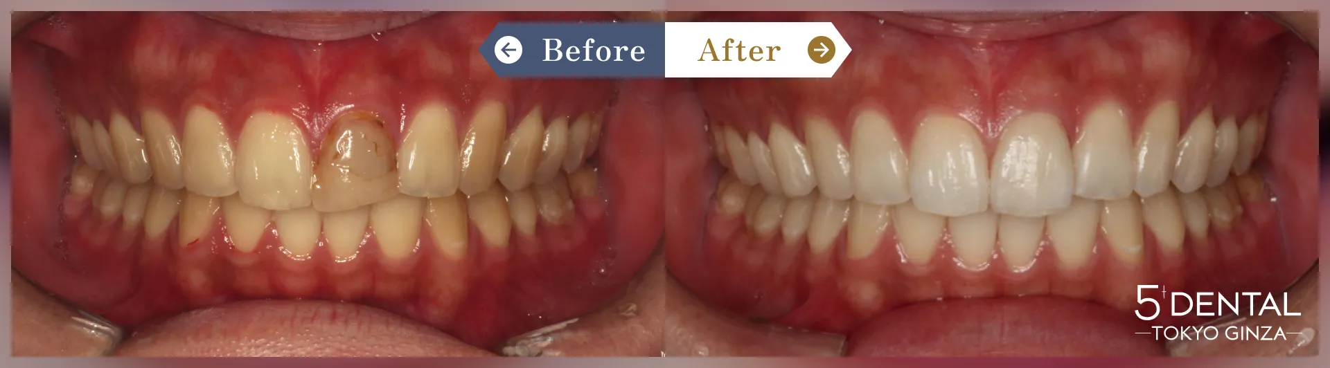失活歯・変色歯 Before/After症例1