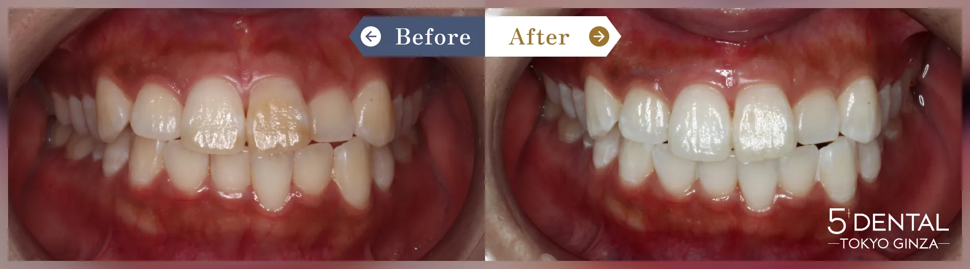 失活歯・変色歯 Before/After症例11