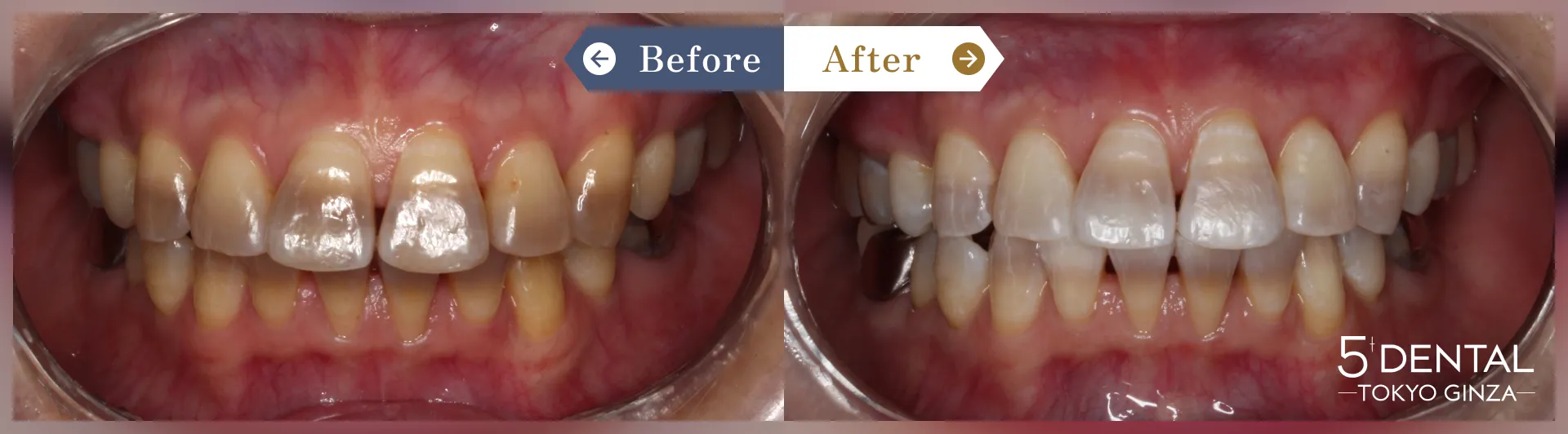 失活歯・変色歯 Before/After症例12