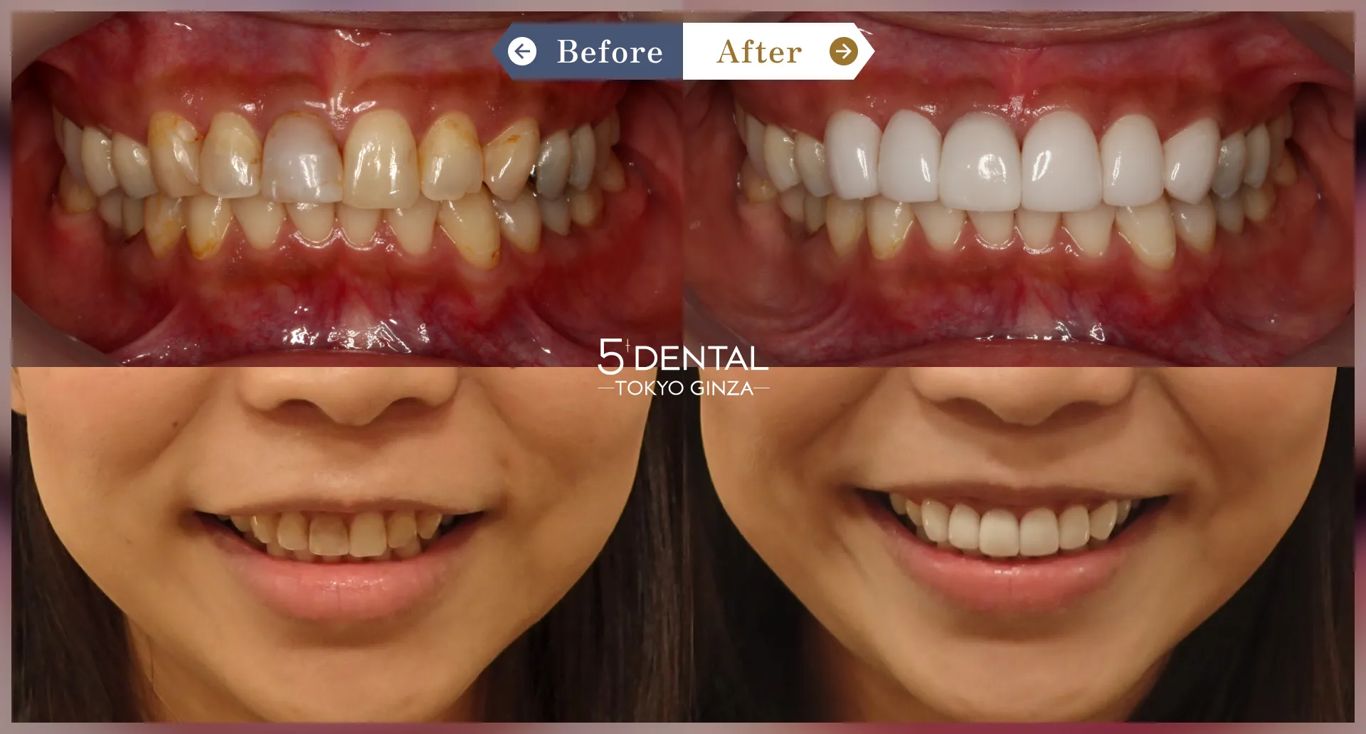 失活歯・変色歯 Before/After症例2