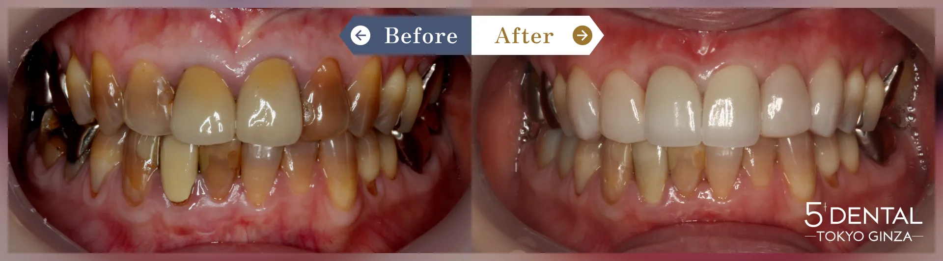 失活歯・変色歯 Before/After症例3