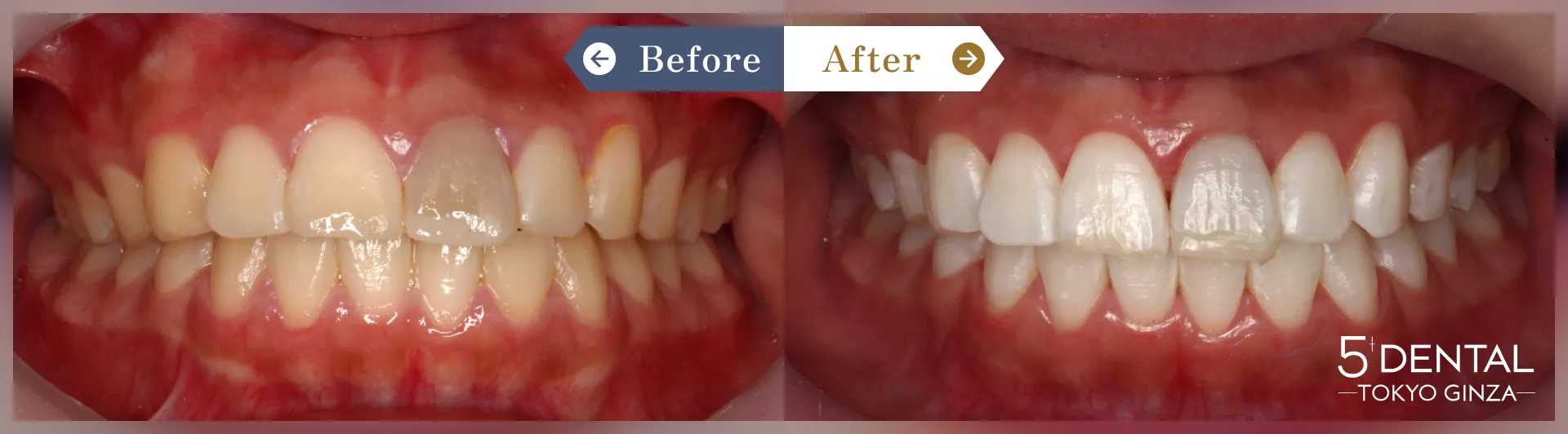 失活歯・変色歯 Before/After症例6