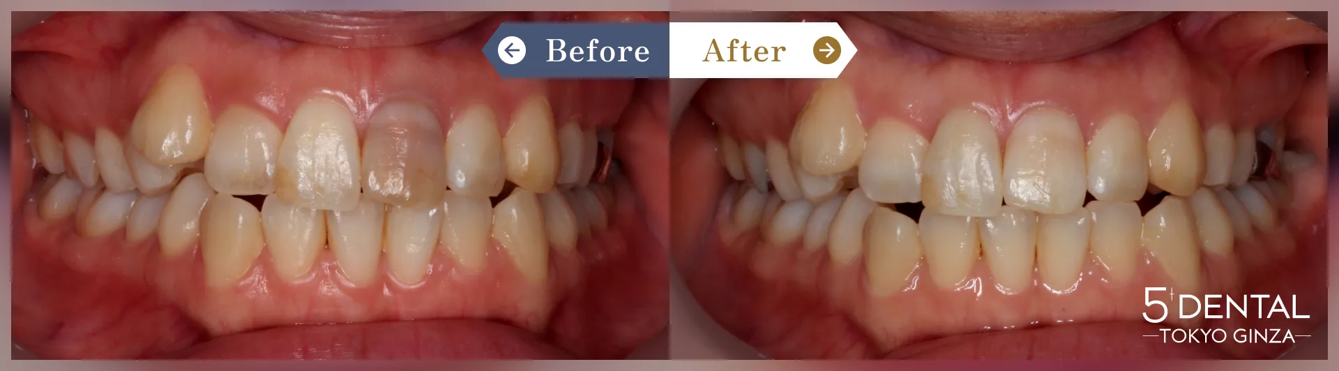失活歯・変色歯 Before/After症例7