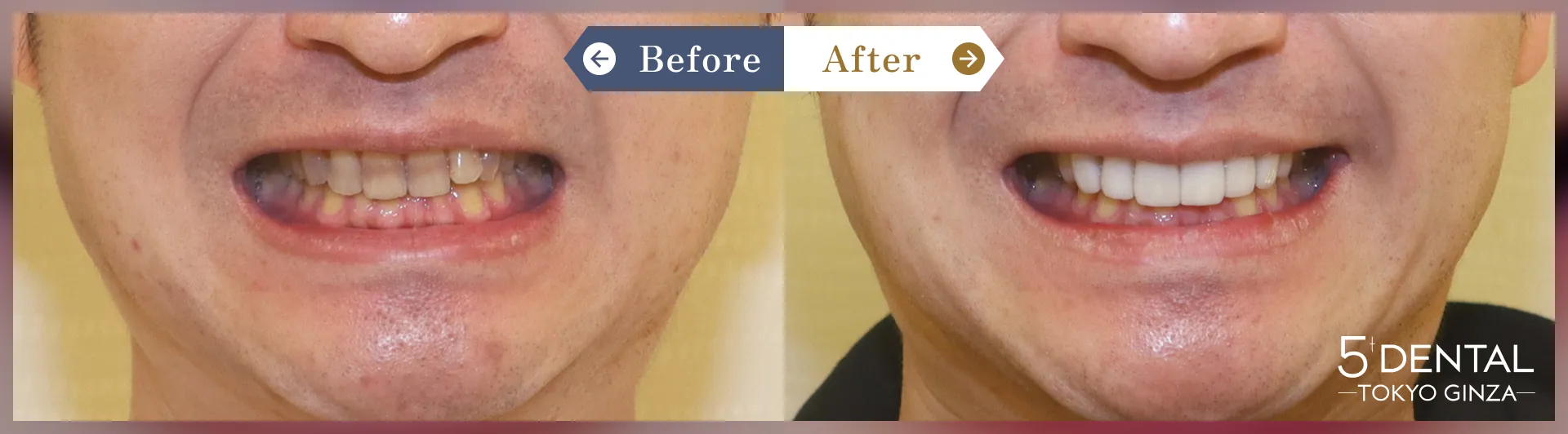 失活歯・変色歯 Before/After症例8