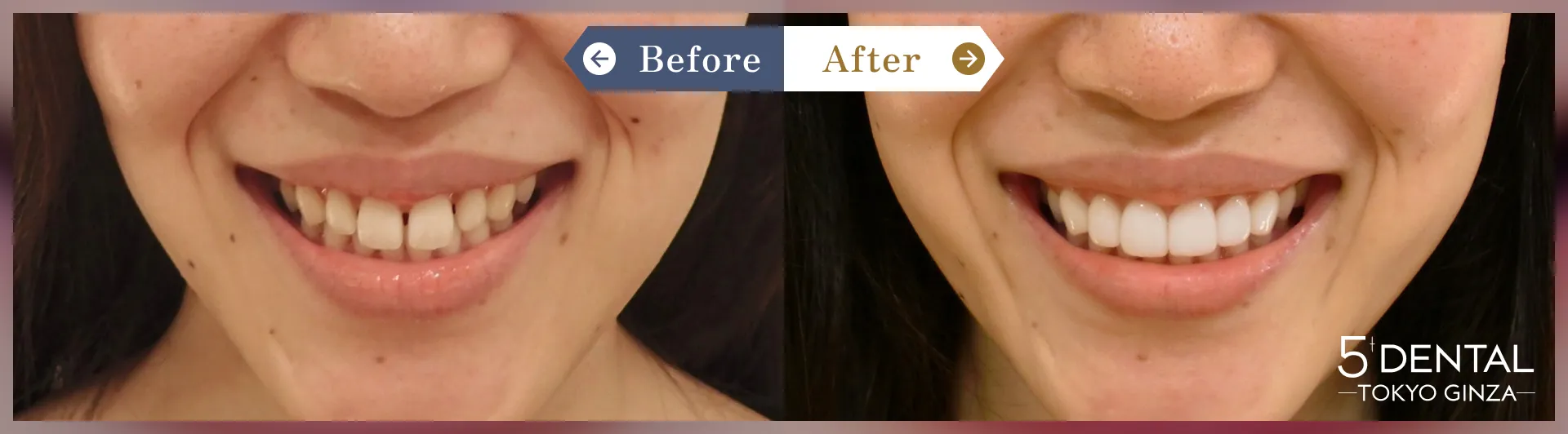 すきっ歯・矮小歯 Before/After症例1