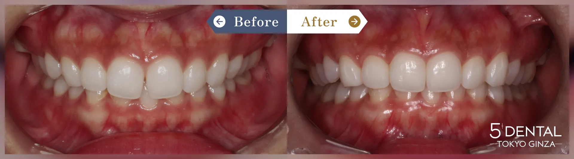 すきっ歯・矮小歯 Before/After症例10