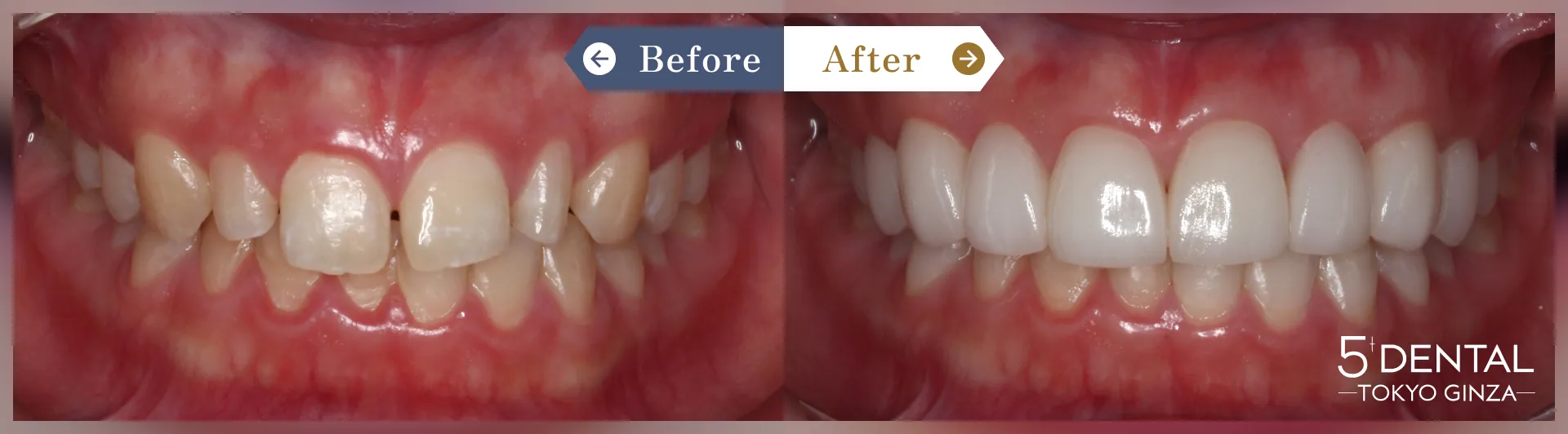 すきっ歯・矮小歯 Before/After症例11
