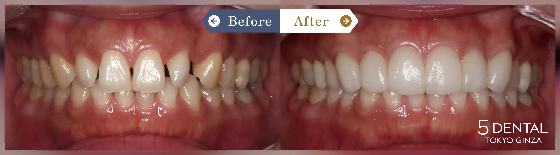 すきっ歯・矮小歯 Before/After症例12