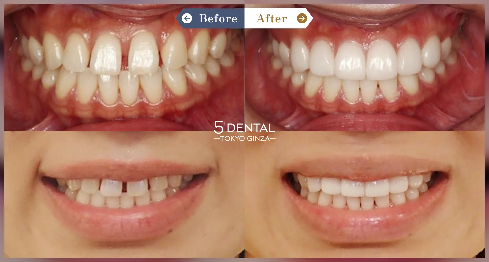 すきっ歯・矮小歯 Before/After症例2