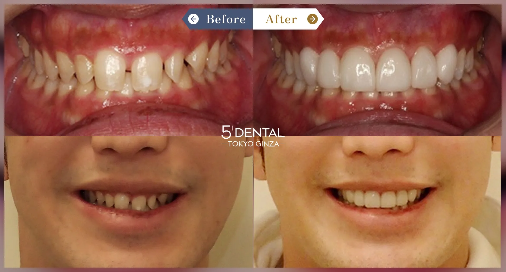 すきっ歯・矮小歯 Before/After症例3