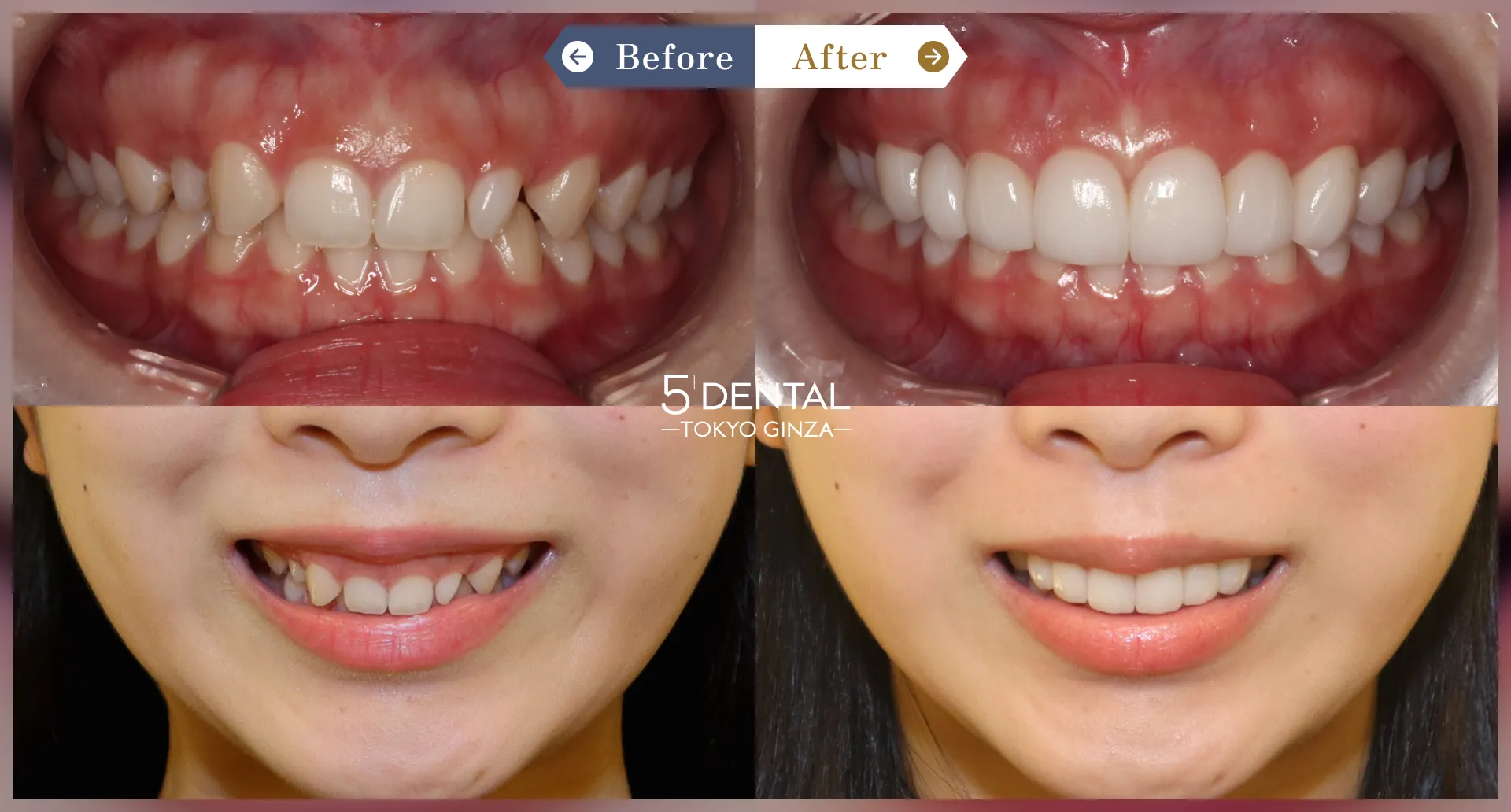 すきっ歯・矮小歯 Before/After症例4