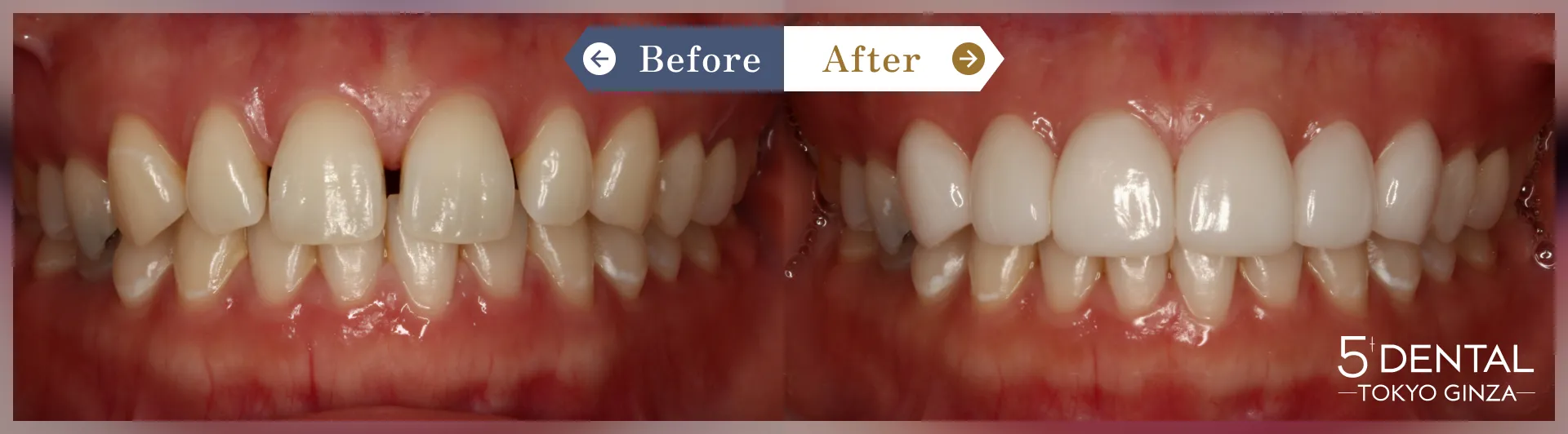 すきっ歯・矮小歯 Before/After症例7