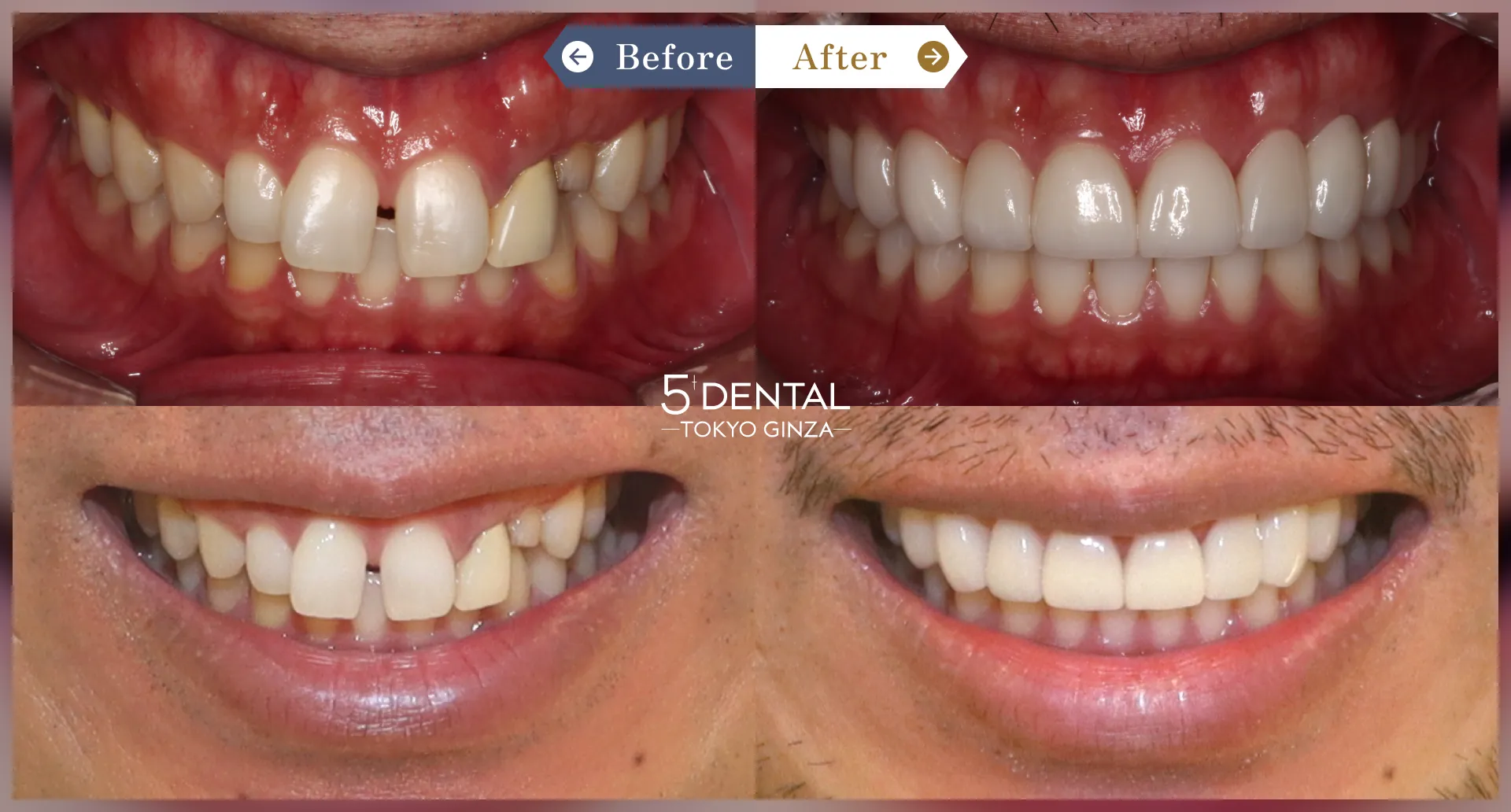 すきっ歯・矮小歯 Before/After症例8