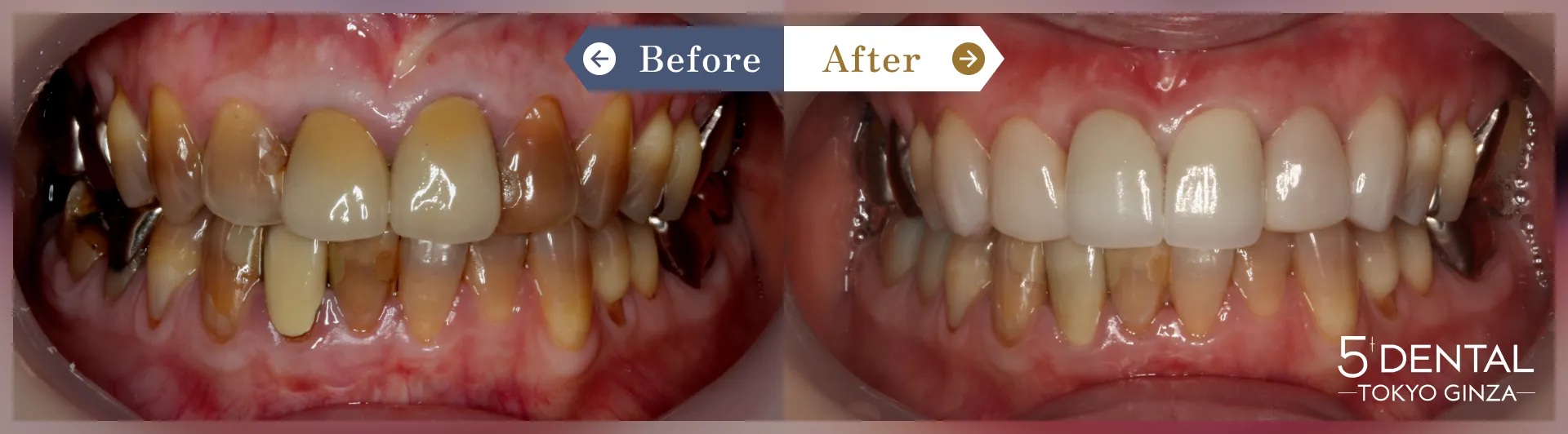 テトラサイクリン歯 Before/After症例3