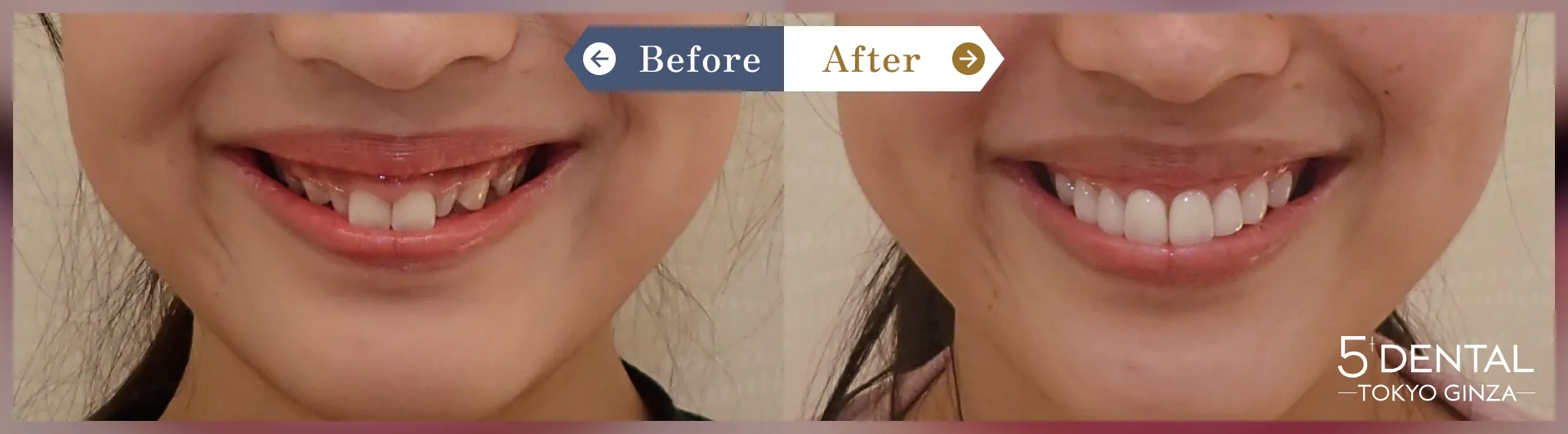 歯を大きくしたい Before/After症例10