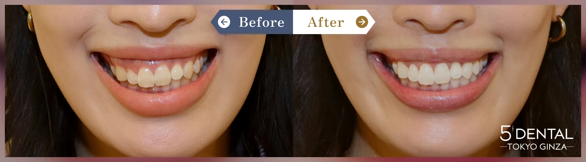 歯を大きくしたい Before/After症例3