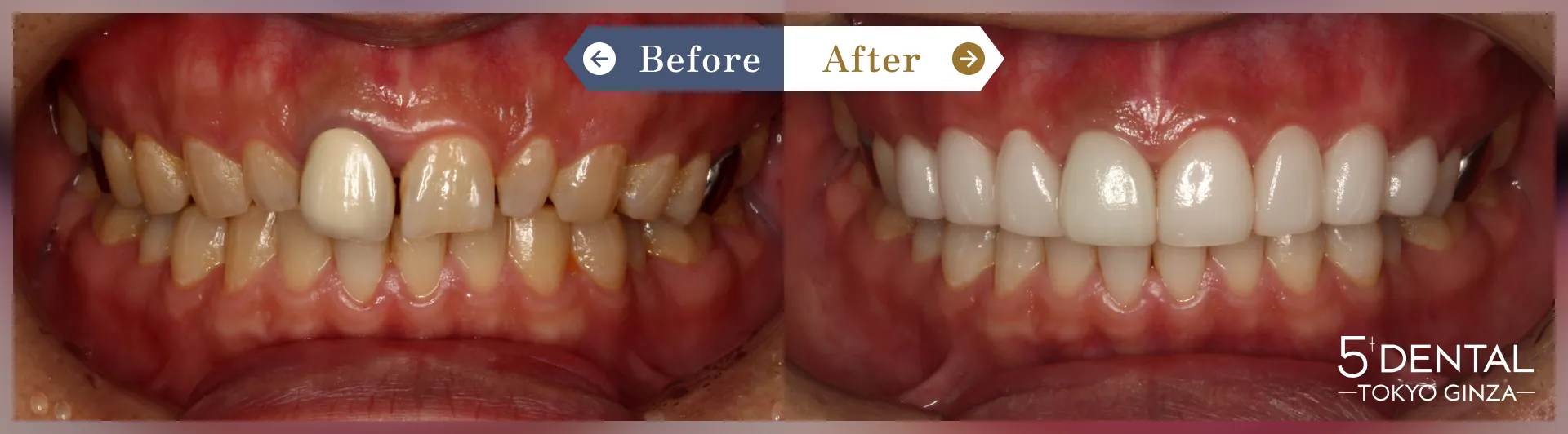 歯を大きくしたい Before/After症例4