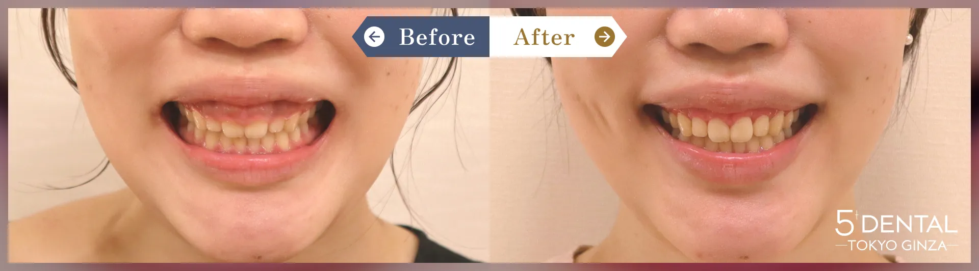 歯を大きくしたい Before/After症例6