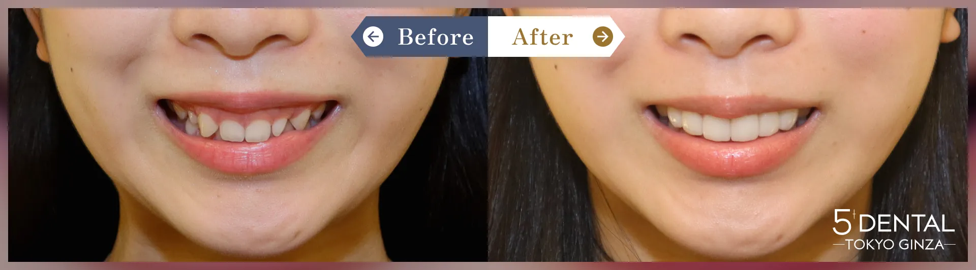 歯を大きくしたい Before/After症例7