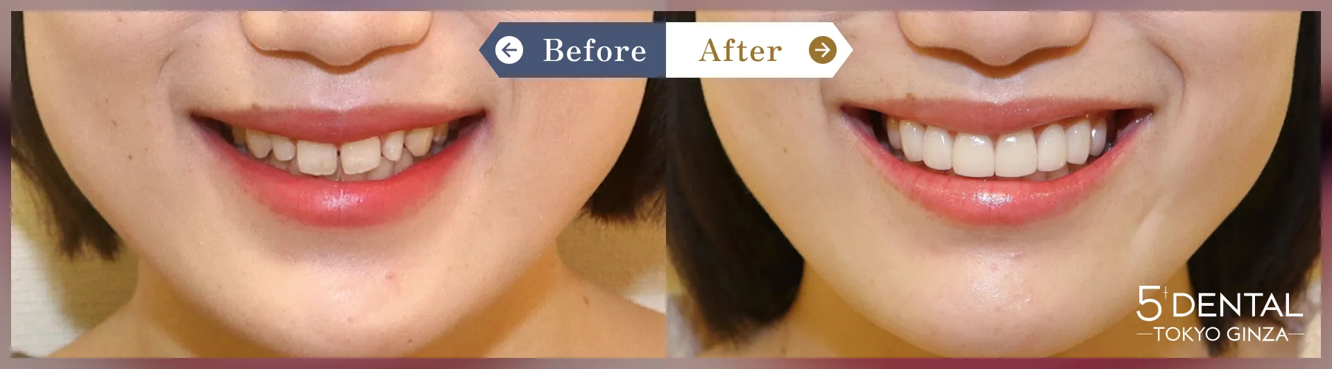 歯を大きくしたい Before/After症例8