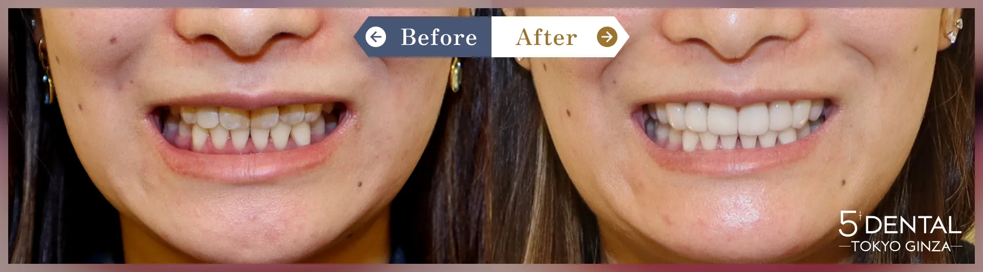 歯を大きくしたい Before/After症例9