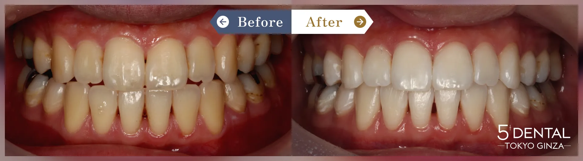 ホワイトニング Before/After症例1