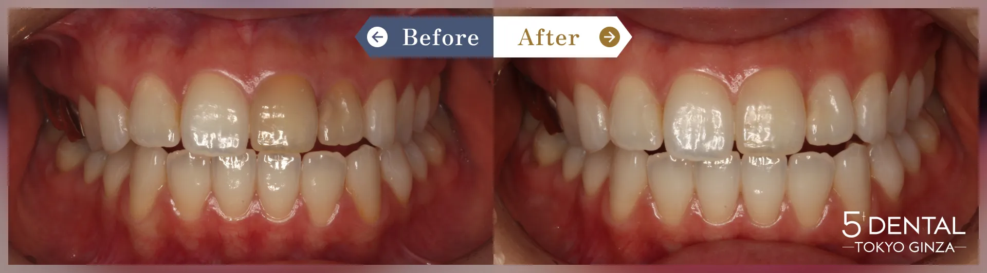 ホワイトニング Before/After症例10