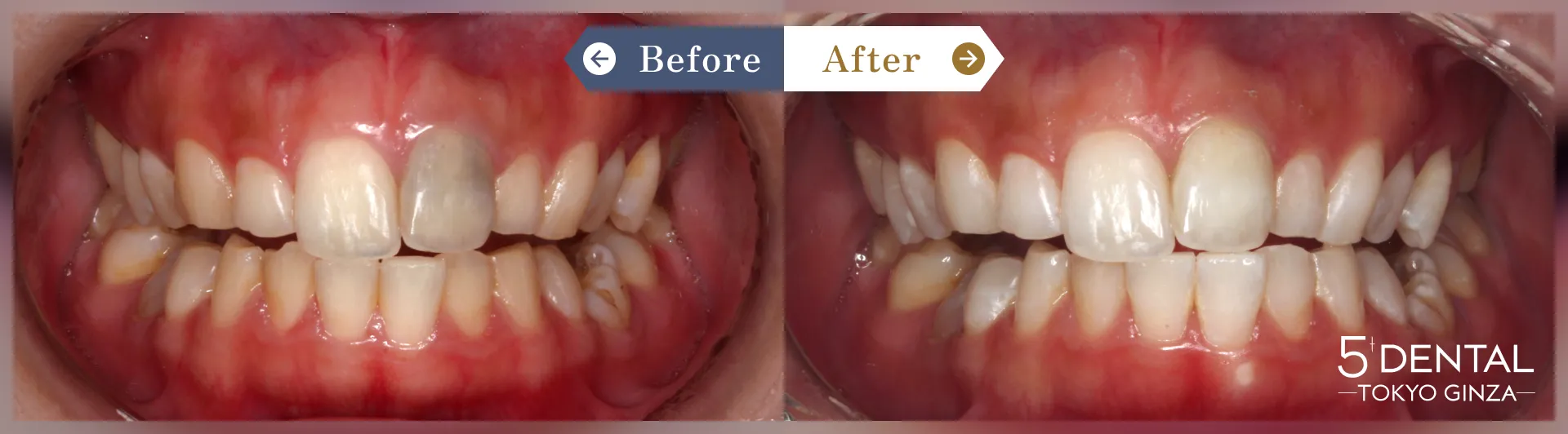 ホワイトニング Before/After症例11