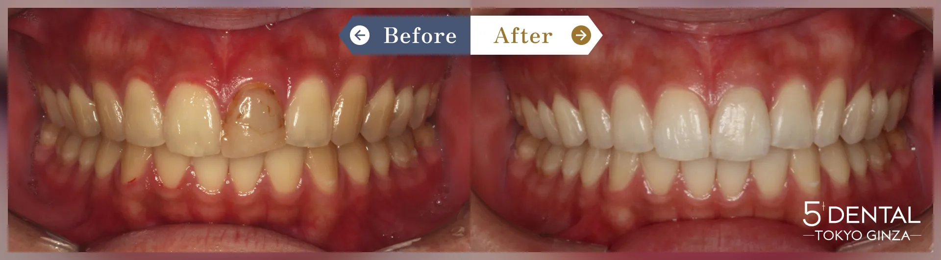ホワイトニング Before/After症例4