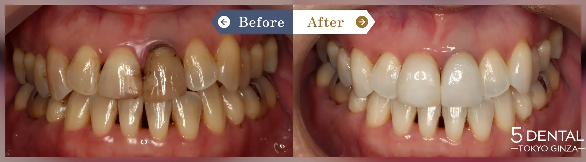 ホワイトニング Before/After症例5