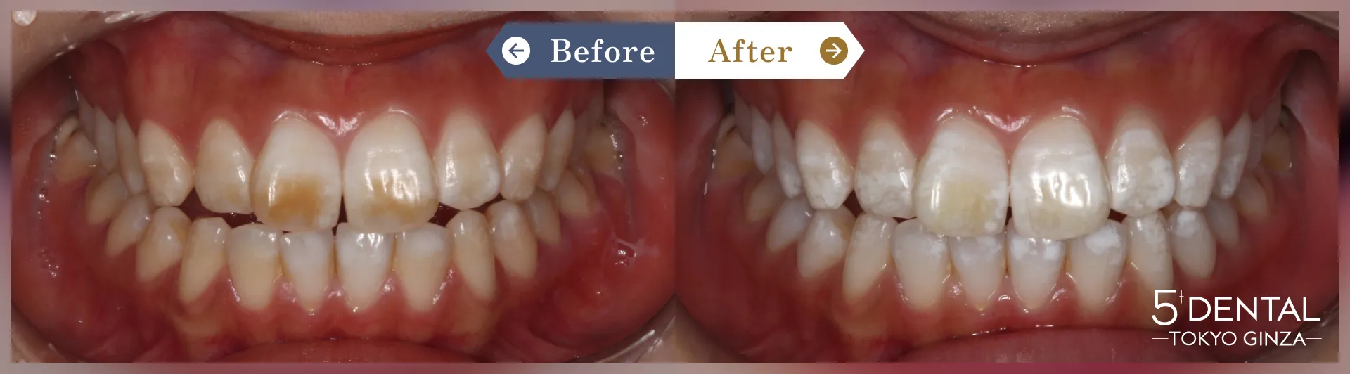 ホワイトニング Before/After症例6-1