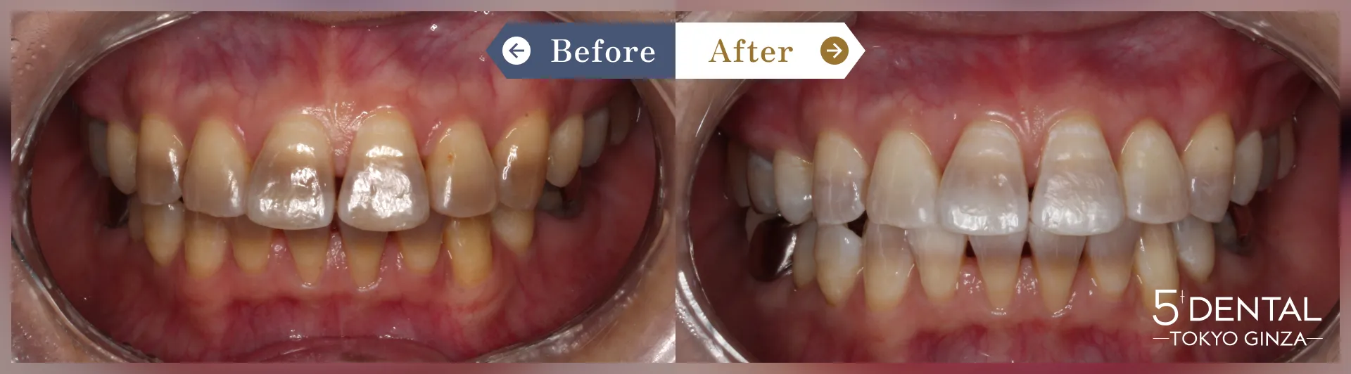 ホワイトニング Before/After症例7-1